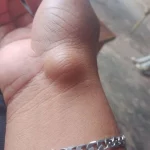 caroço na pele