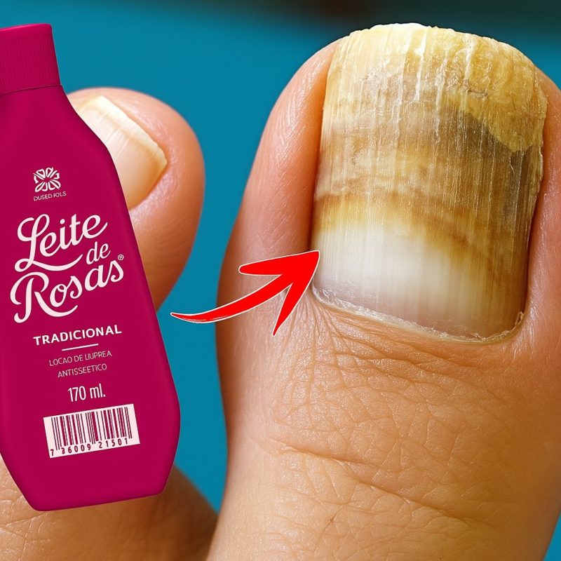 micose de unha com leite de rosas